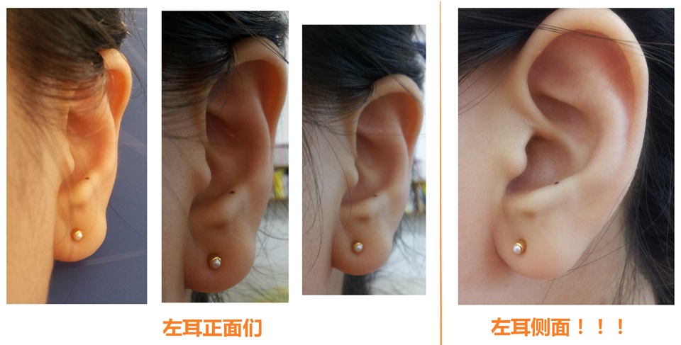 耳洞打偏了怎么办啊啊啊啊